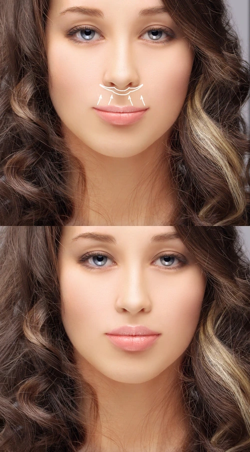 lip-lift-buza-superioara-cluj lip-lift-buza-superioara-cluj